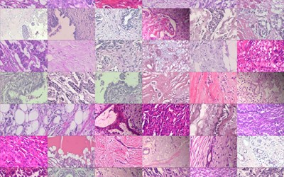 Semi-supervised learning for R&D of AI-powered cancer pathology