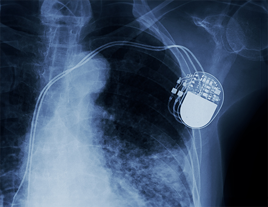 Will wireless charging power a transformative future for implantable medical devices?