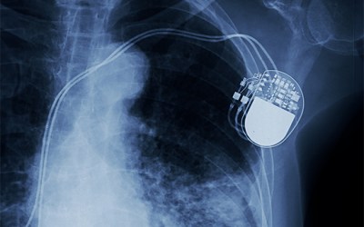 Will wireless charging power a transformative future for implantable medical devices?